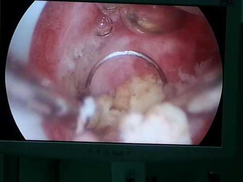 宫腔镜手术后出血多久