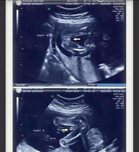 民间看胎儿男女方法是否有用呢？这些告诉你真相！