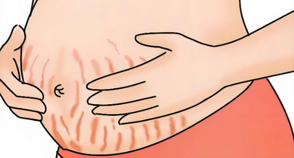 6大科学方法有效预防妊娠纹！孕妈必备的抗纹攻略，速收藏！