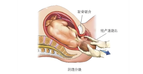 顺产如何正确发力？3 步精准用力法（超详细），帮你缩短产程！