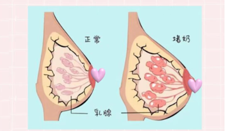 4 个 “致命误区”,哺乳期堵奶时坚决别碰,90%产后妈妈都中招!