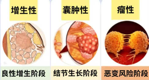 乳腺结节 4 级 = 癌症前兆？别瞎慌！医生拆解分级背后的真相