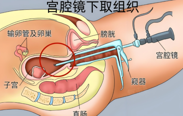 别再怕宫腔镜！是什么、要做吗、注意什么？一文说透！