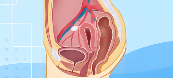 腰坠胀、下腹疼,久坐的你要注意!可能是盆腔积液,要不要治看这