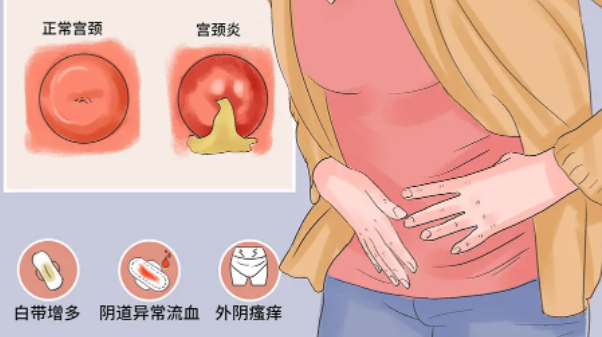 夏天阴道炎高发？妇科医生：记住这6点，远离瘙痒异味！