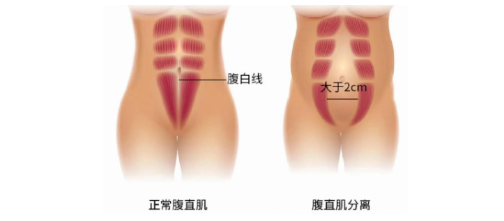 产后肚子松垮的真相：腹直肌分离怎么测？怎么练？一篇讲透！