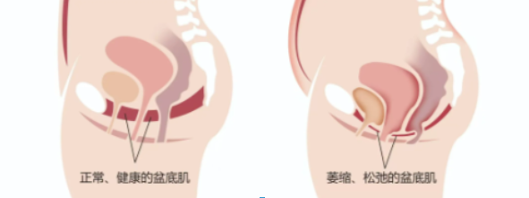 产后盆底肌修复，医院 vs 家用仪器，到底怎么选？