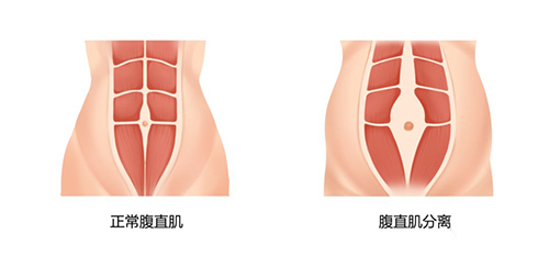 腹直肌分离