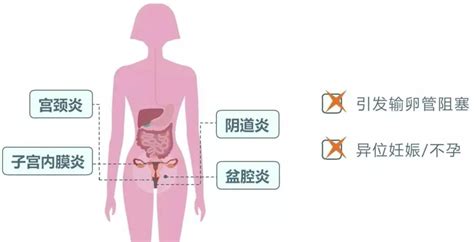 女性导致不孕不育的病有哪些