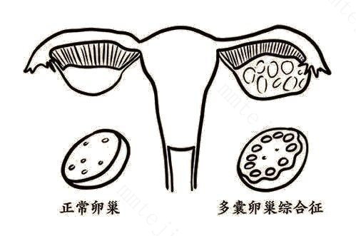 女性多囊更容易患双胞胎吗？是福还是祸