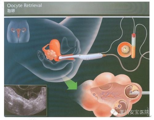 取卵前有哪些注意事项