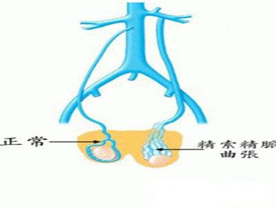 患精索静脉曲张的原因