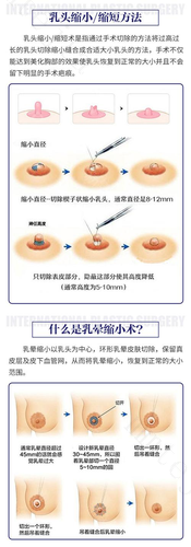 乳晕缩小手术的危害