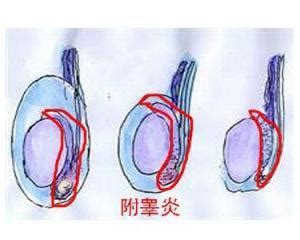 治疗附睾炎的偏方奇方