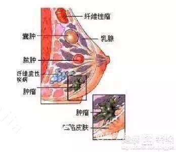 备孕得乳房纤维瘤怎么办