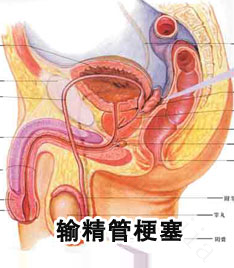 输精管堵塞有什么感觉