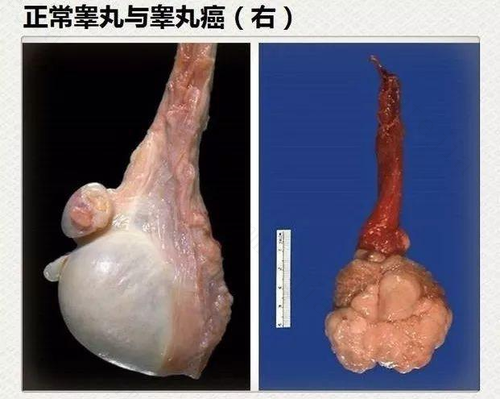 治疗睾丸癌的偏方