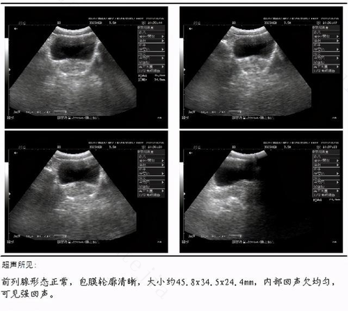 前列腺钙化是什么意思 详解前列腺钙化的意思