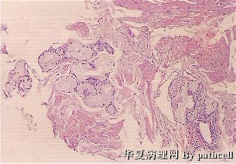 做完前列腺穿刺后多久可以散步吗