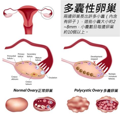 内分泌紊乱会不孕吗?