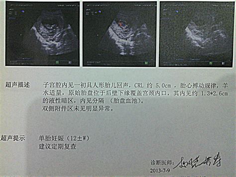 宫颈检查出血正常吗 宫颈检查有出血状况正常吗