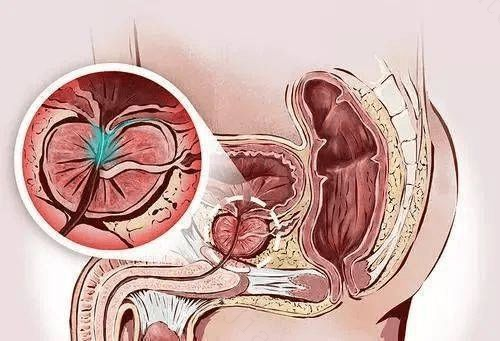 慢性前列腺炎对生育的影响