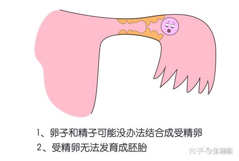 输卵管不通的几种情况