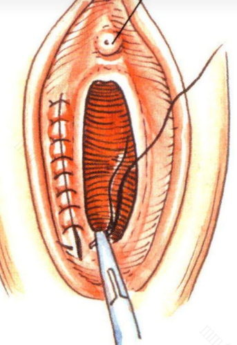 前庭大腺囊肿会自己消失吗