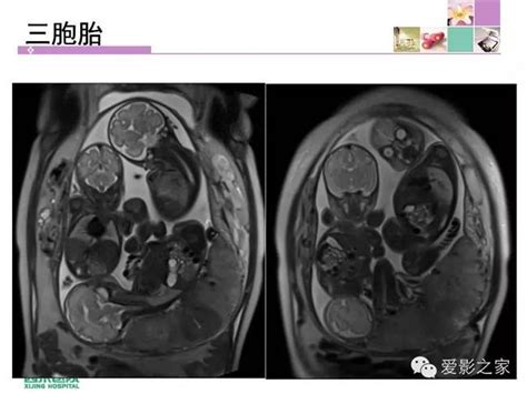 什么样的人会生畸形儿