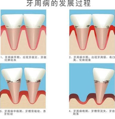 慢性盆腔炎治疗费用多少钱