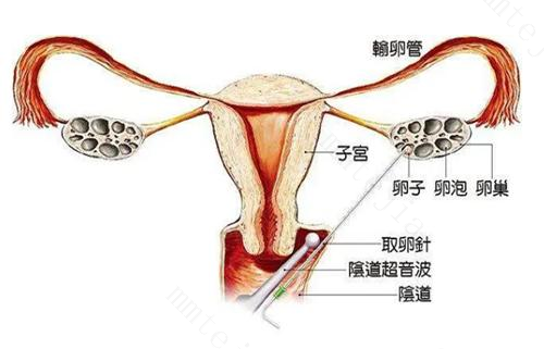 卵泡穿刺术需要多久时间