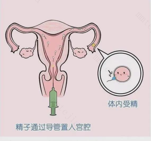 人工授精一般几次成功 放缓心态最重要