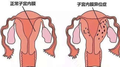 正视子宫内膜异位造成的不孕，如何成功受孕顺利生出小孩？