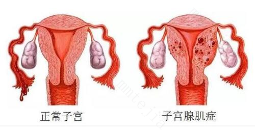 子宫腺肌症是什么原因引起的