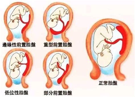 怎样预防子宫肌瘤的发生