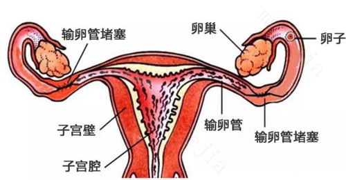 输卵管不通做哪些运动