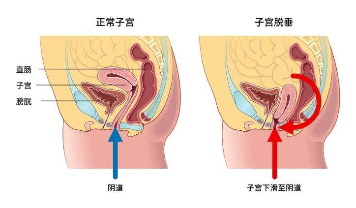 产后出现漏尿 再做盆底修复还有用吗