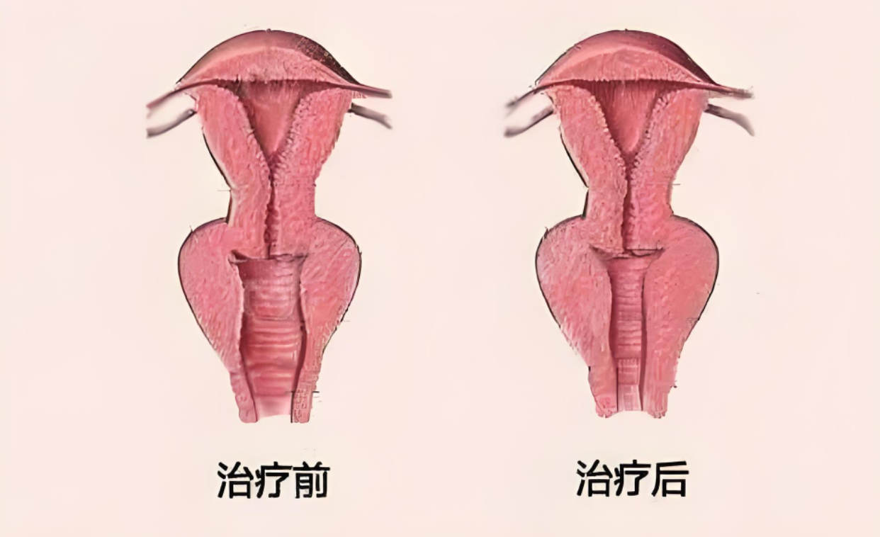 全景透视-女性私处整形：为爱“挨刀”，冒这些风险值得吗？