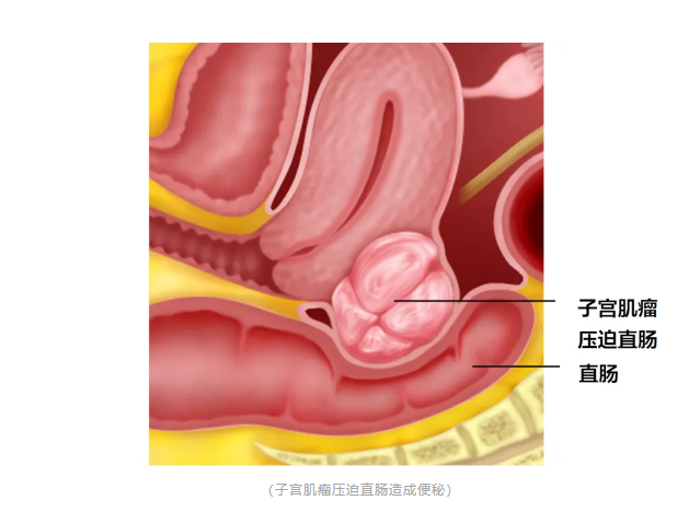 切除子宫后，女人面临的6大后果，每一个都很扎心！