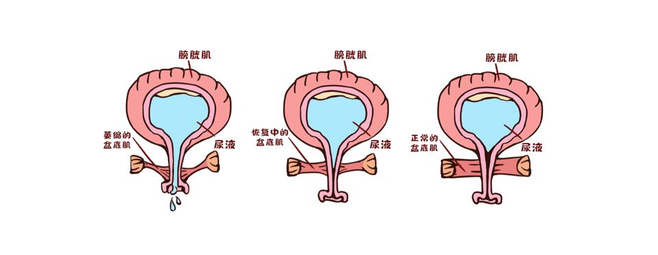 产后尿频的真正原因找到了，如何改善是关键！