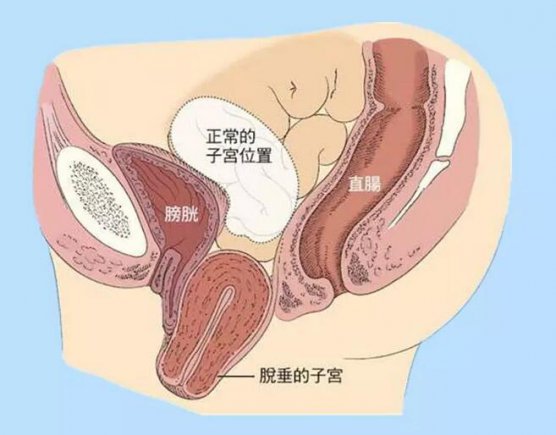 产后花两千块钱治疗盆底肌，有必要吗？