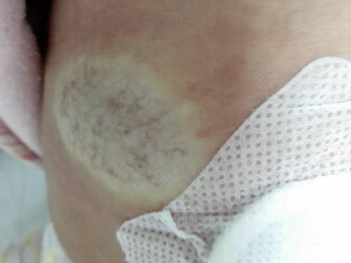 秋季宝宝肚脐血管瘤要怎么护理？ 宝宝肚脐上长了血管瘤怎么办