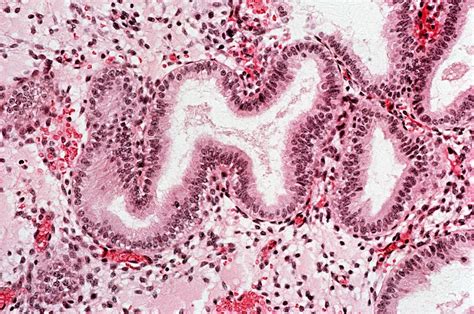 子宫内膜6mm算薄吗 子宫内膜6.6mm算薄吗