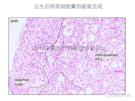 女人性冷淡易发乳腺癌 什么样的女人易得乳腺癌